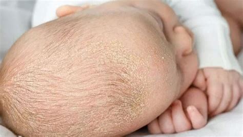 bebeklerde konak karbonat